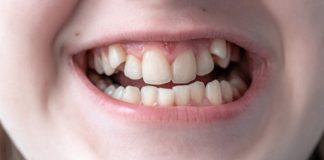 Adults Can Still Have their Teeth Straightened with Braces Invisalign