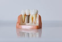 Practical Tips on How to Get Ready for a Dental Implant Surgery Practical Tips on How to Get Ready for a Dental Implant Surgery
