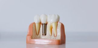 Practical Tips on How to Get Ready for a Dental Implant Surgery