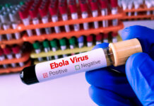 Blood sample for Ebola virus test to identify viral hemorrhagic fever.